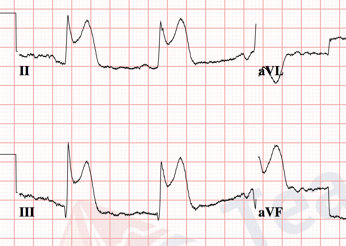 practice ekg rhythm strips