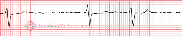 wavy garbage with NO P waves = atrial fibrillation (usually)