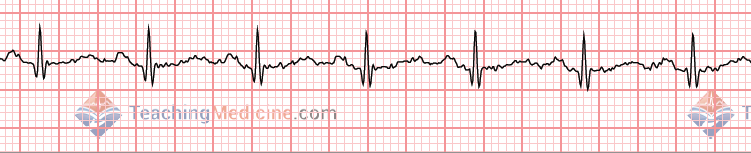 wavy garbage WITH P waves and T waves easily seen = artifact