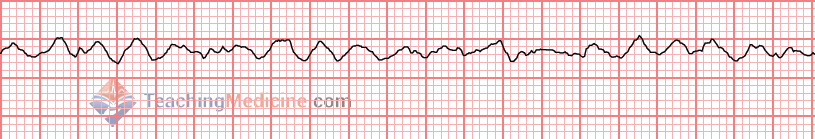 wavy garbage and NO QRS = ventricular fibrillation