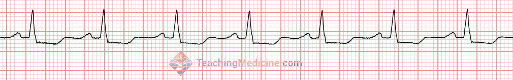 P wave shape and size