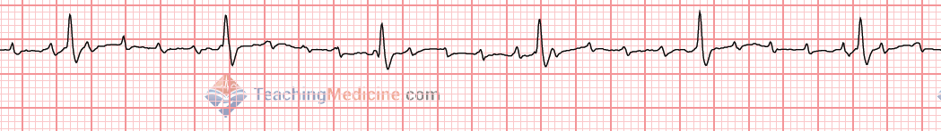 unknown PR interval