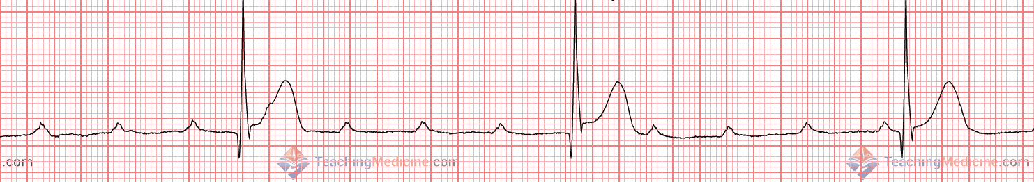 no PR interval from 3rd degree heart block