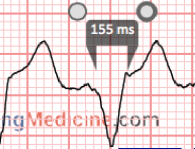 QRS duration is 155 msec
