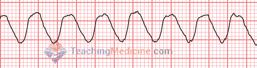 Very wide QRS