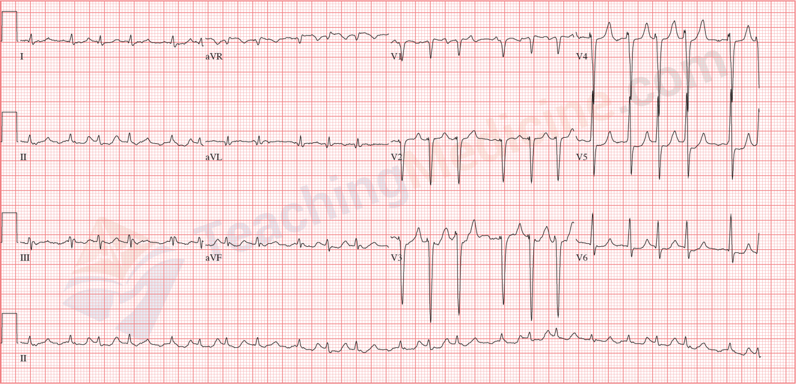 atrial fibrillation