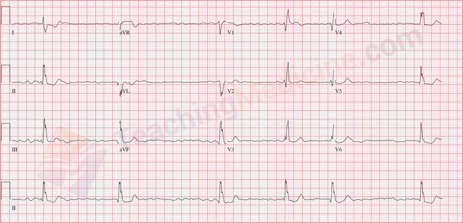 atrial fibrillation