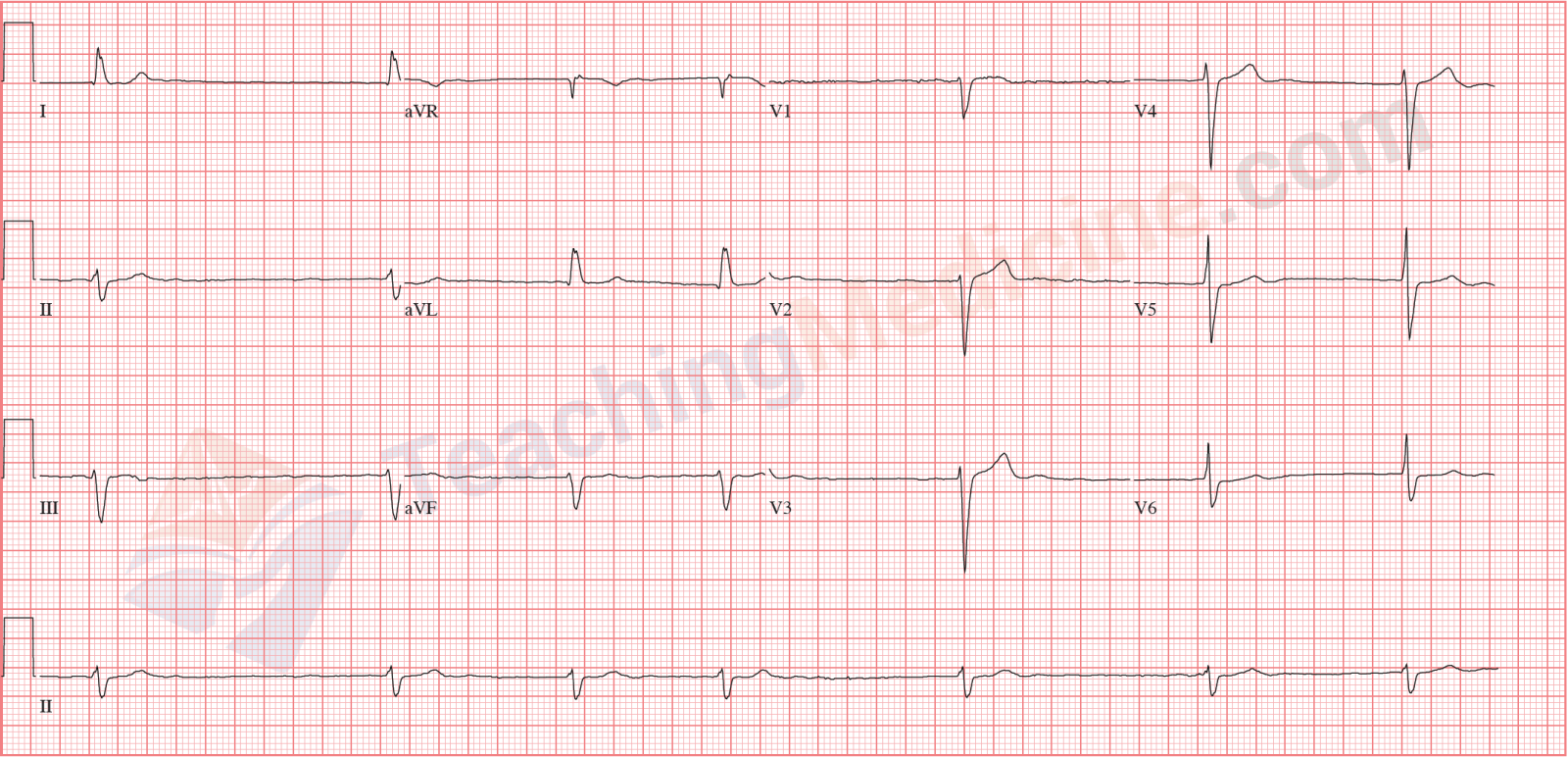 atrial fibrillation