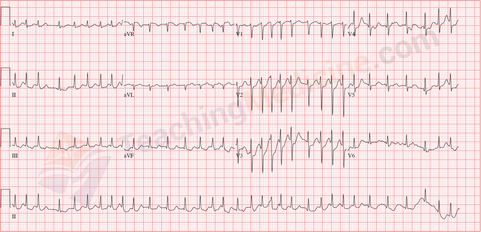 atrial fibrillation