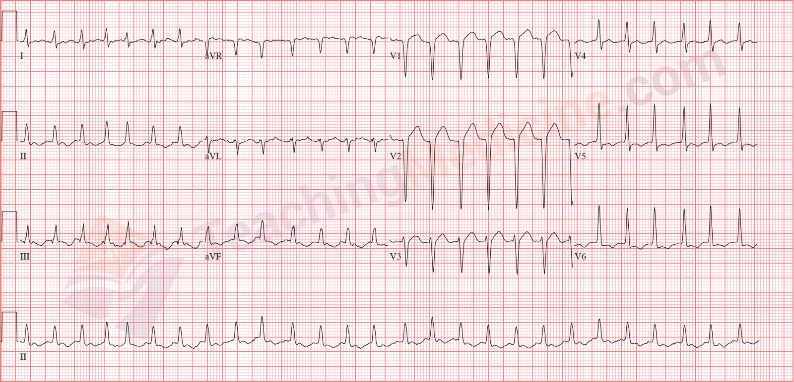 atrial fibrillation