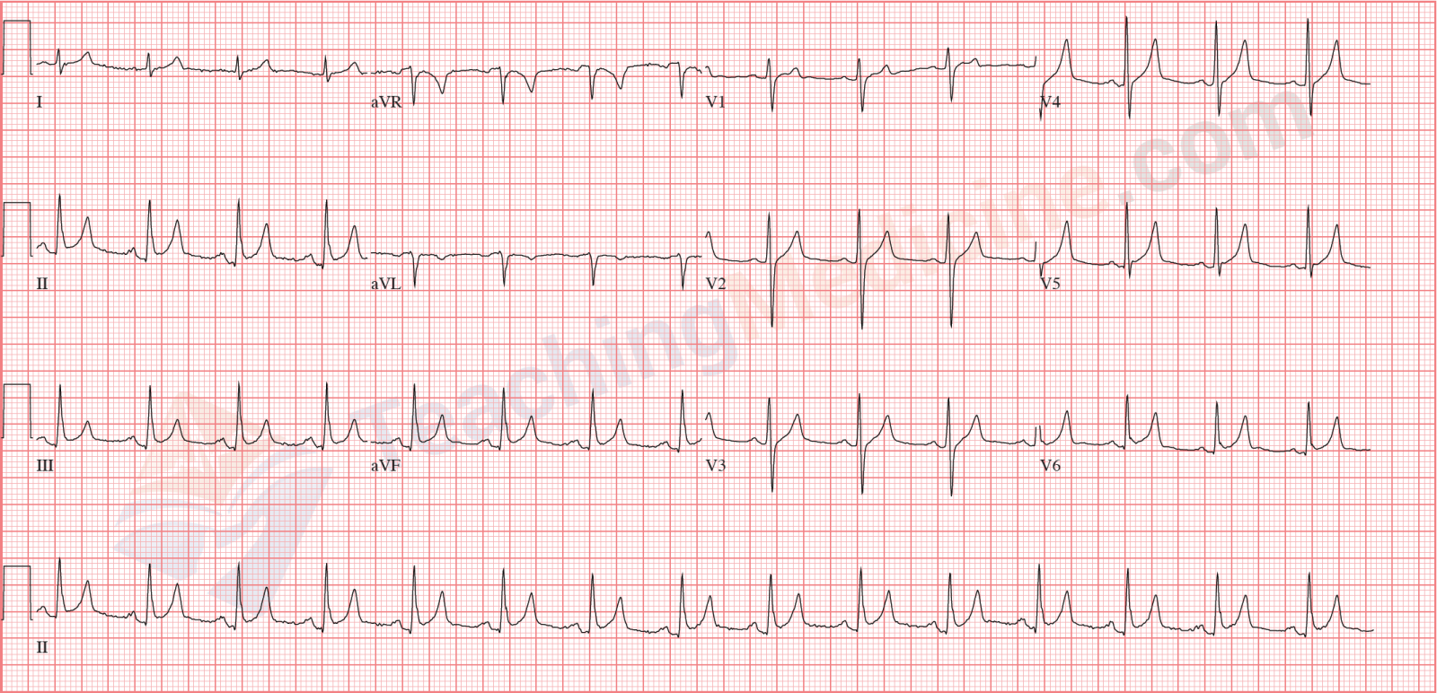 normal sinus rhythm