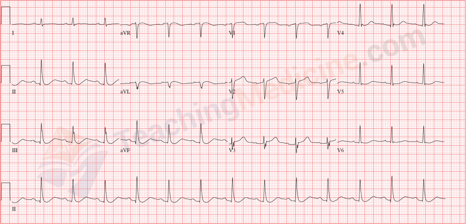 normal sinus rhythm