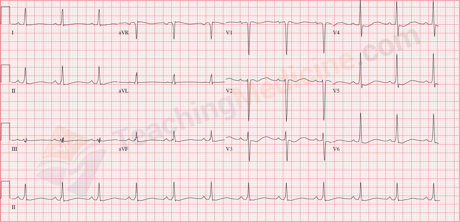 normal sinus rhythm