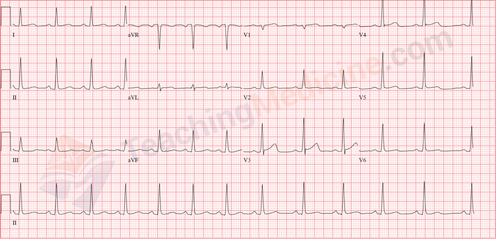 normal sinus rhythm