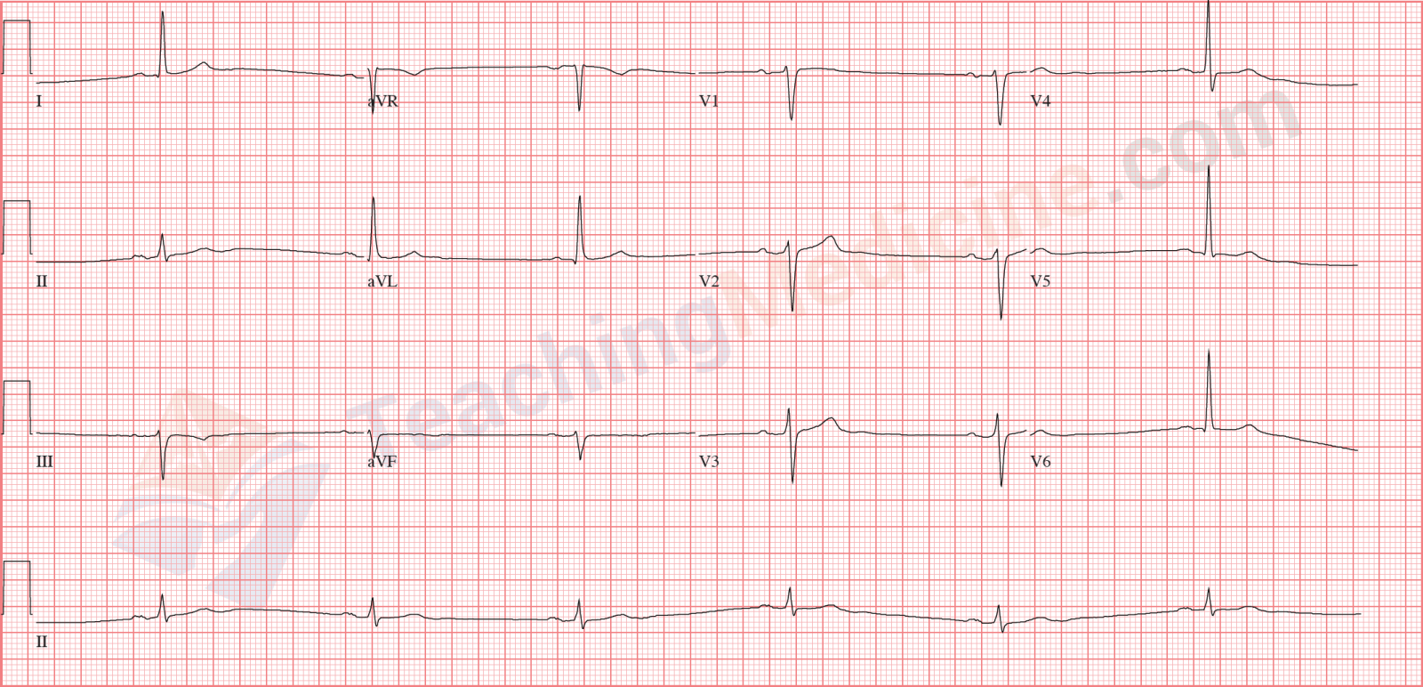 Teaching Medicine Tutorial Rhythm Diagnostic Criteria