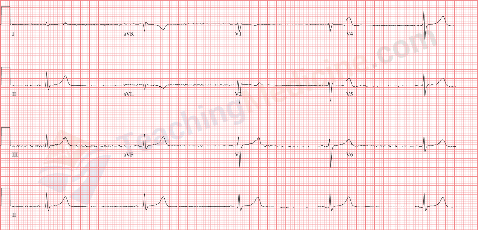 sinus bradycardia