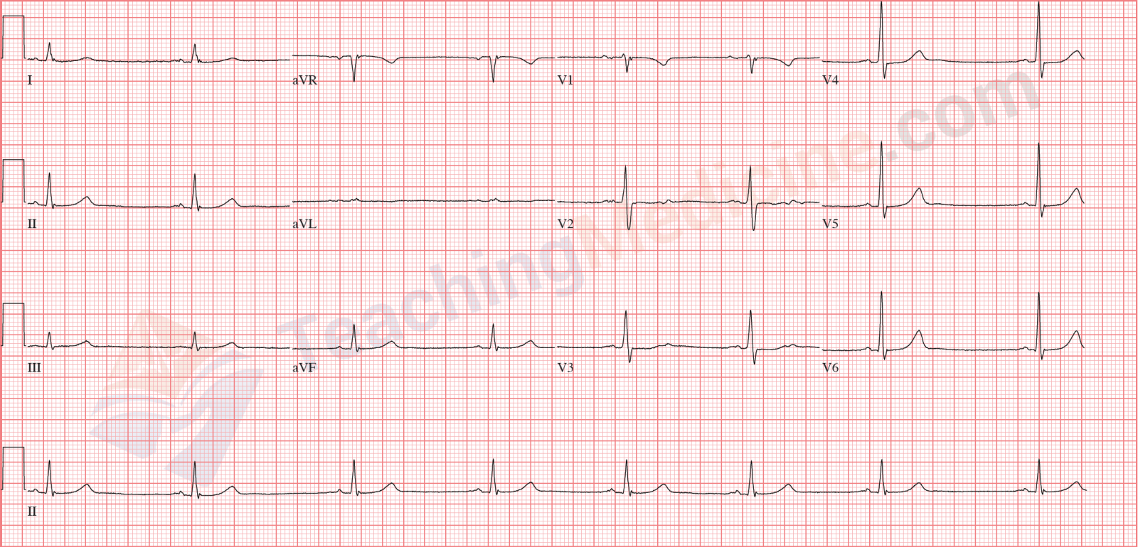 sinus bradycardia