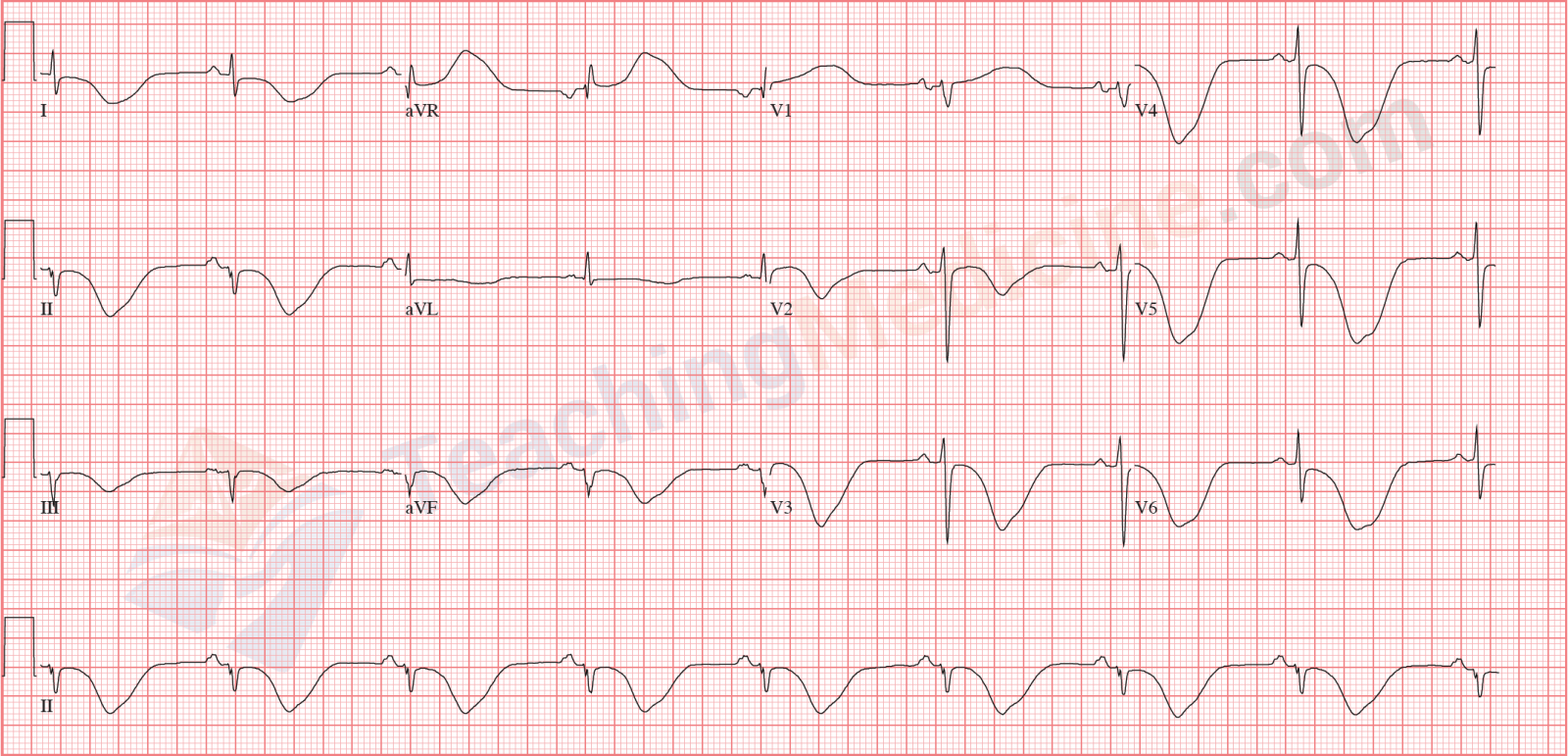 sinus bradycardia