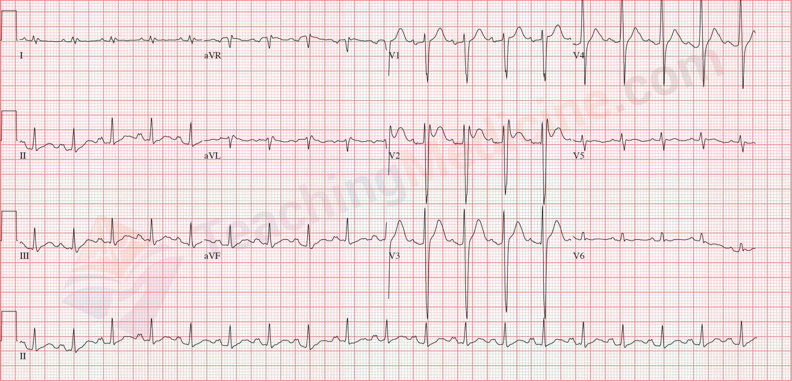 sinus tachycardia