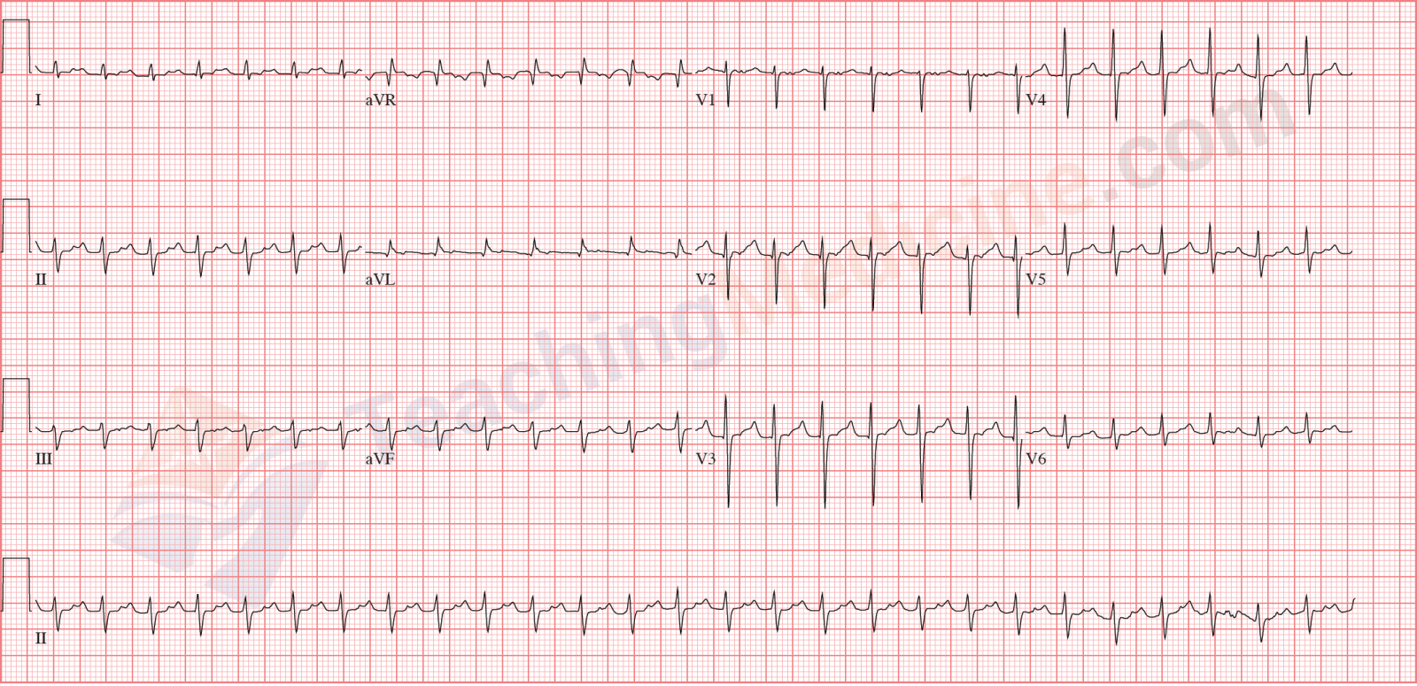 sinus tachycardia