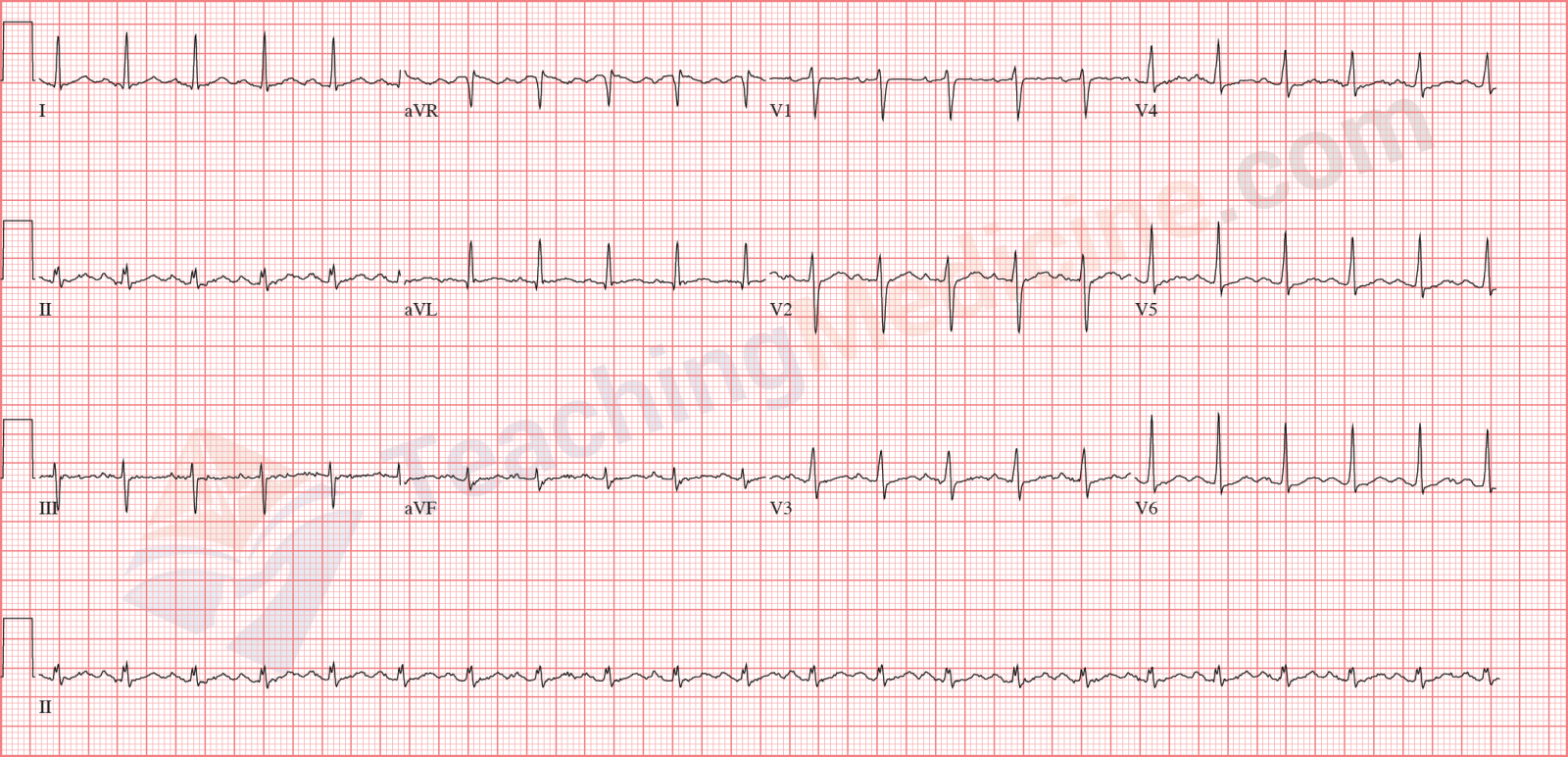 sinus tachycardia