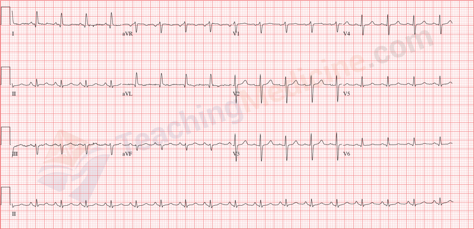 sinus tachycardia