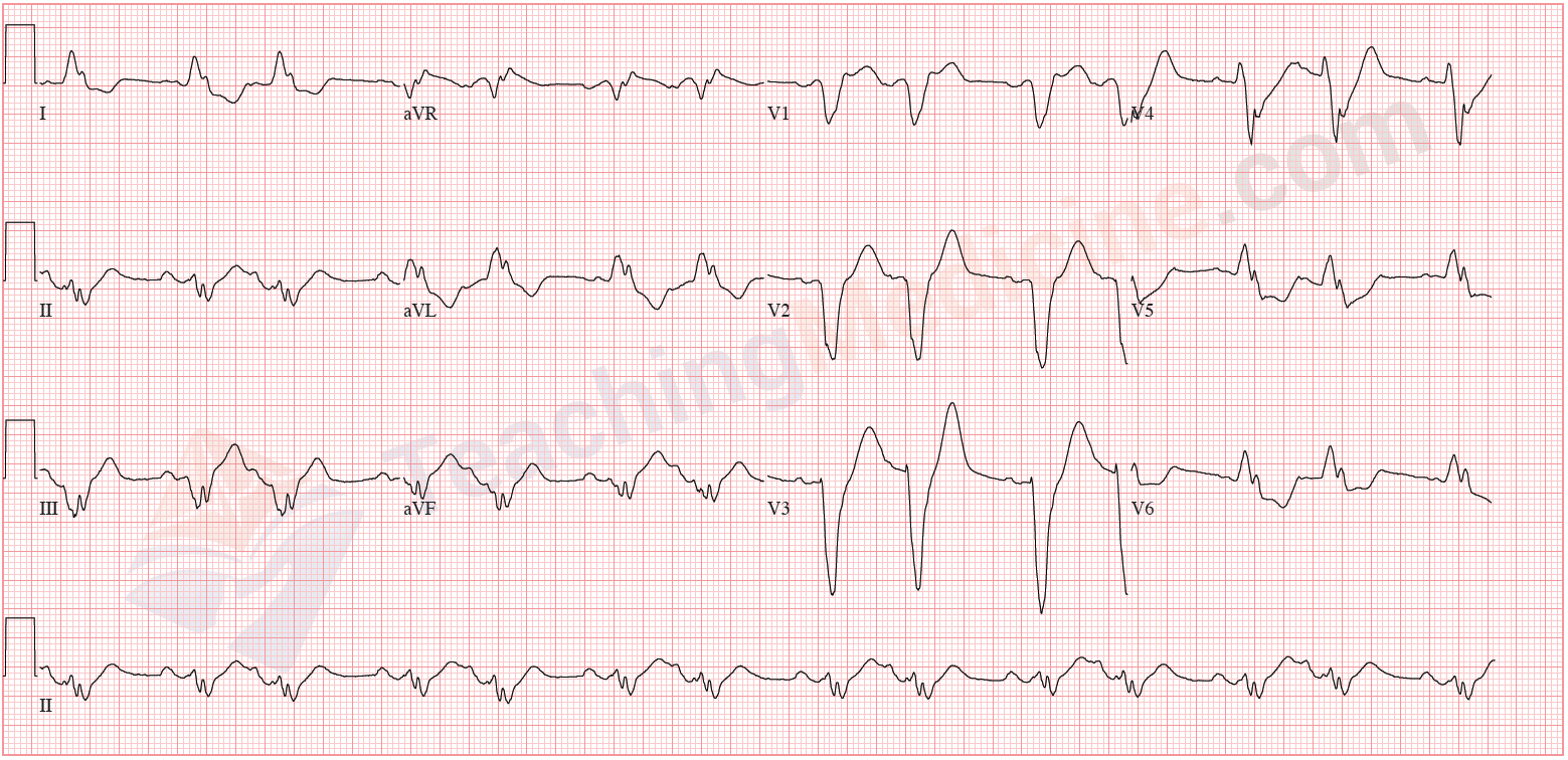 ECG LAD axis