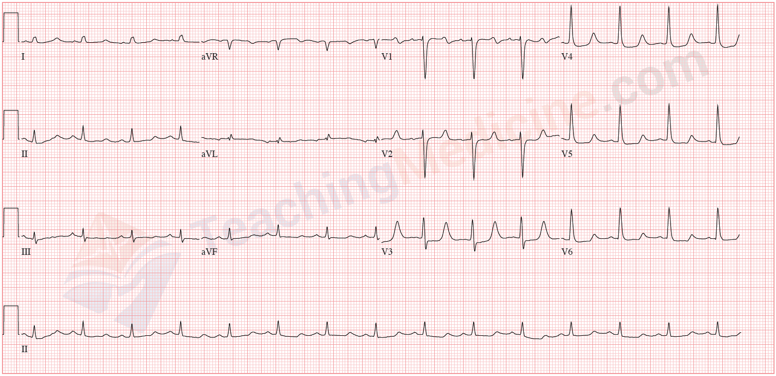 isoelectric ECG lead