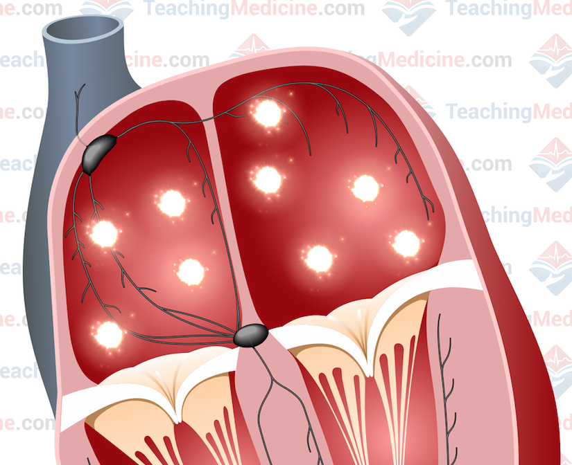 multiple atrial re-entry circuits