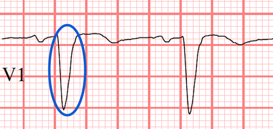 S wave in V1