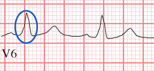 LBBB ECG