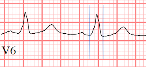 LBBB ECG