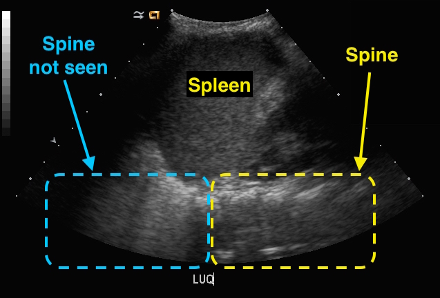spine sign on ultrasound