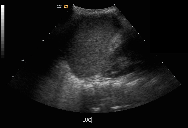 spine sign on ultrasound