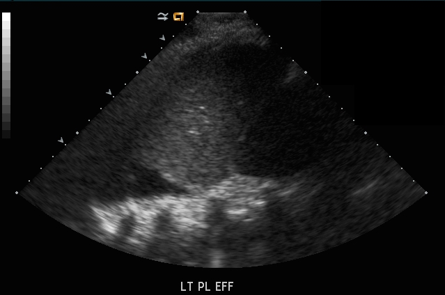 spine sign on ultrasound