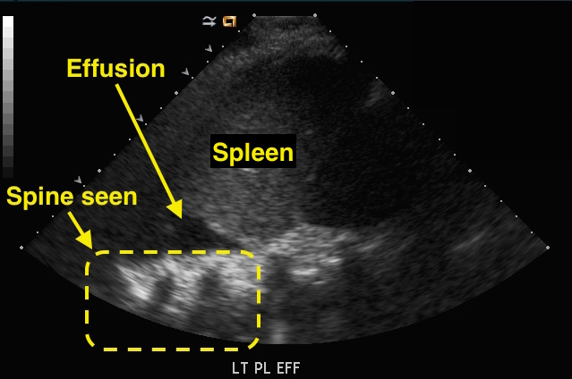 spine sign on ultrasound