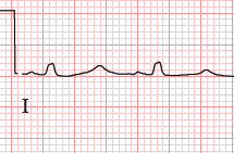 ECG isoelectric lead