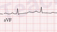 ECG isoelectric lead