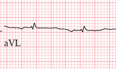 ECG isoelectric lead