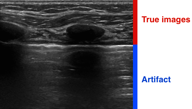 rib artifact on ultrasound