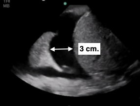 pleural effusion on ultrasound