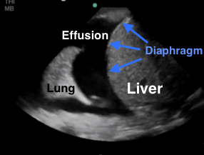 pleural effusion on ultrasound
