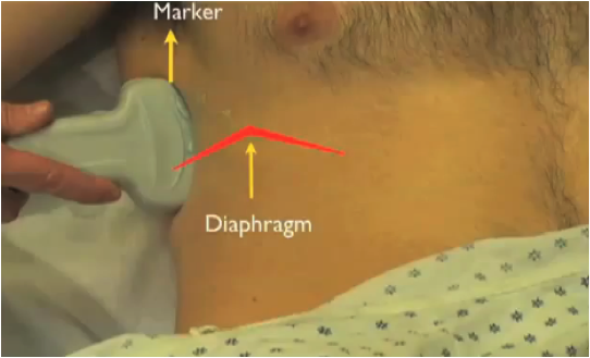 probe placement for lung ultrasound