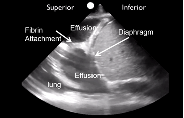 loculated effusion on ultrasound