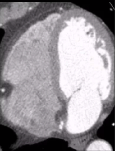 CT scan of heart