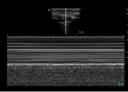 seashore sign on lung ultrasound