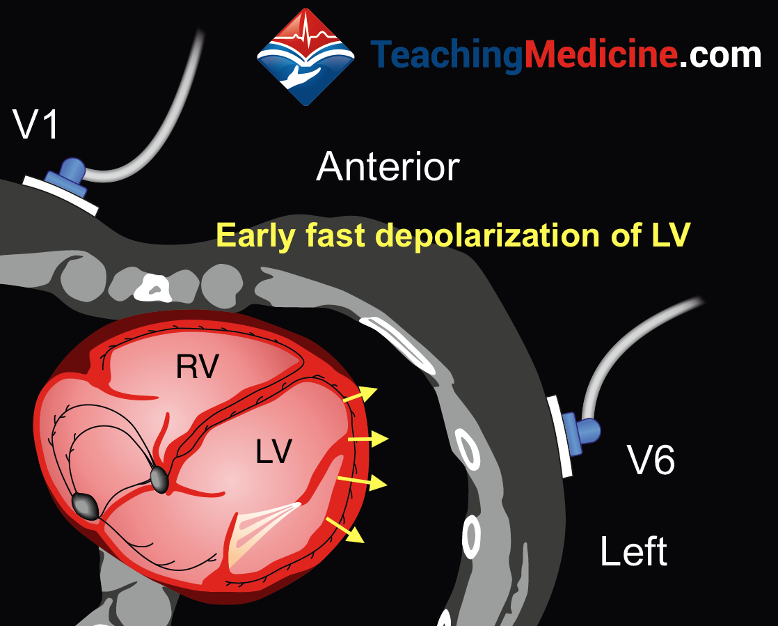 RBBB ECG