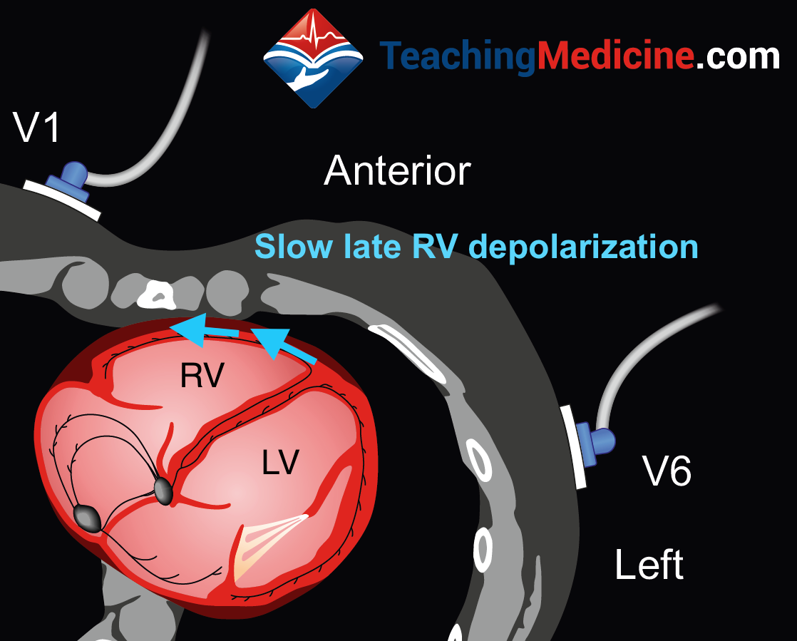 RBBB ECG