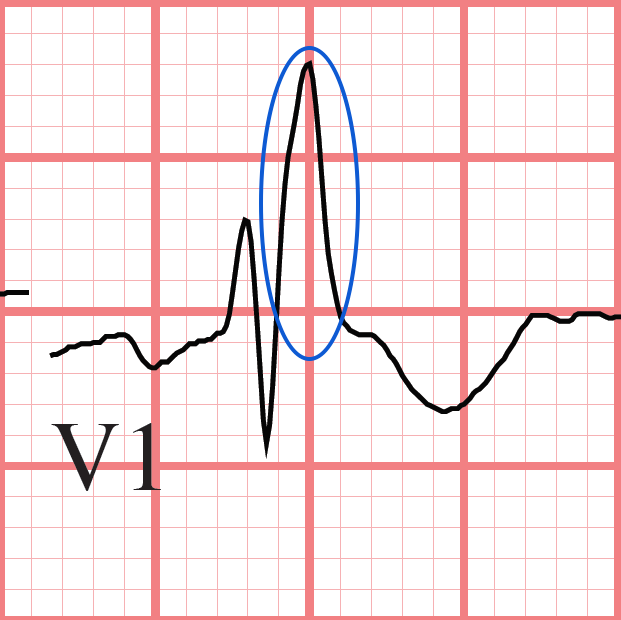 RBBB ECG