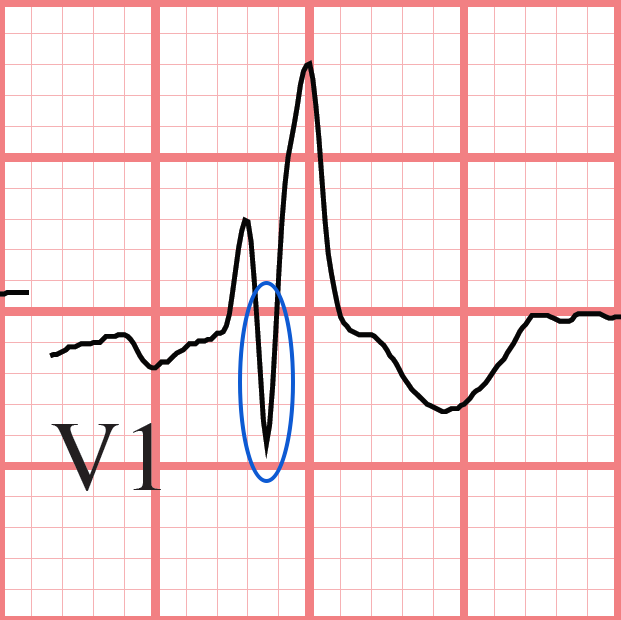 RBBB ECG